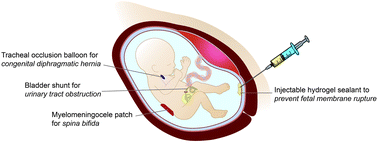 Graphical abstract: Biomaterials in fetal surgery