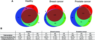 Graphical abstract: A protein corona sensor array detects breast and prostate cancers