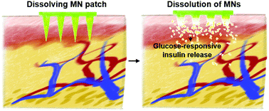 Graphical abstract: A dissolving and glucose-responsive insulin-releasing microneedle patch for type 1 diabetes therapy