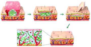 Graphical abstract: Pressure-driven spreadable deferoxamine-laden hydrogels for vascularized skin flaps
