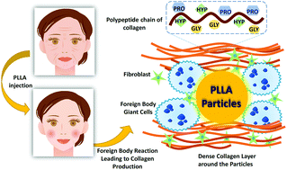 Graphical abstract: Collagen and the effect of poly-l-lactic acid based materials on its synthesis