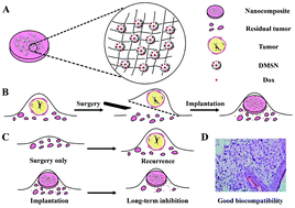Graphical abstract: A nanoparticle-containing polycaprolactone implant for combating post-resection breast cancer recurrence