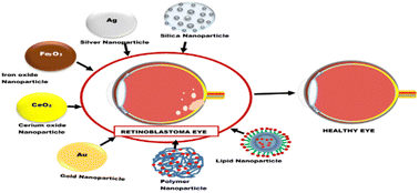 Graphical abstract: Nanoparticle-based delivery systems as emerging therapy in retinoblastoma: recent advances, challenges and prospects