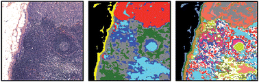 Graphical abstract: Detection of breast micro-metastases in axillary lymph nodes by infrared micro-spectral imaging