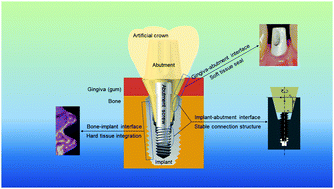 Graphical abstract: Three interfaces of the dental implant system and their clinical effects on hard and soft tissues