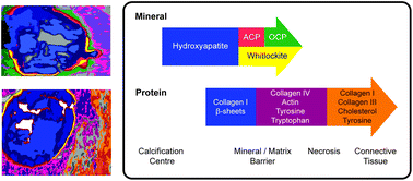 Graphical abstract: A multi-modal exploration of heterogeneous physico–chemical properties of DCIS breast microcalcifications