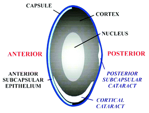 Schematic cross section of the lens demonstrating various zones and forms of age-related cataract.