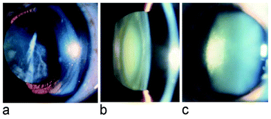 a) frontal view of a cortical cataract, b) cross sectional view (slit lamp) of a nuclear cataract, c) slit lamp view of a posterior subcapsular cataract.