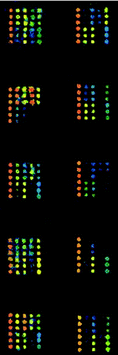 Scan images of SARS-CoV structure protein screening microarrays incubated with 5 positive sera and 5 negative sera at 532 nm detection wavelength. The left column is positive and the right column is negative.