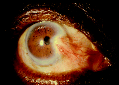 Photograph of a pterygium.