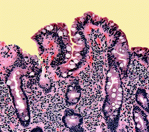 Coeliac disease prevents essential nutrients being absorbed in the gut.