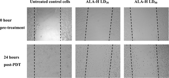 The typical inhibition of cell migration of MED cells treated with ALA-H-PDT. A wound was made to the confluent cells. Images were taken at pre- and post-PDT under phase-contrast microscopy. The images of the untreated control cells indicated the wound was healed normally after 24 h incubation. For the cells treated with ALA-H at LD30 and LD50, only a small amount of cell migrated from the wounded area. At 24 h post ALA-H-PDT, the cells treated at LD30 still strongly attached to the well plate; whereas most of the cells treated at LD50 became loosely attached and floating nucleus resulted in less invasive.