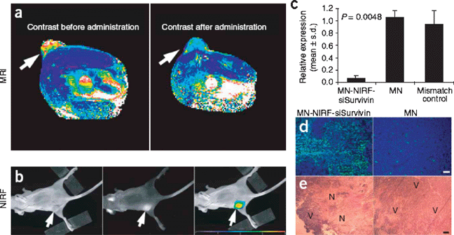 Application of MN-NIRF-siSurvivin in a therapeutic tumor model. (a) In vivo MRI of mice bearing subcutaneous LS174T human colorectal adenocarcinoma (arrows). (b) A high-intensity NIRF signal on in vivo optical images associated with the tumor following injection of MN-NIRF-siSurvivin confirmed the delivery of the probe to this tissue (left, white light; middle, NIRF; right, color-coded overlay). (c) Quantitative RT-PCR analysis of survivin expression in LS174T tumors after injection with either MN-NIRF-siSurvivin, a mismatch control or the parental magnetic nanoparticle (MN). (d) Note distinct areas with a high density of apoptotic nuclei (green) in tumors treated with MN-NIRF-siSurvivin (left). (e) H&E staining of frozen tumor sections revealed considerable eosinophilic areas of tumor necrosis (N) in tumors treated with MN-NIRF-siSurvivin (left). Reproduced with permission from ref. 49.