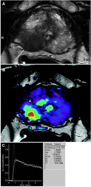(A) Axial T2 image of prostate with a tumor (arrow). (B) DCE-MRI using low molecular weight contrast agent (Gd-DTPA). (C) Time intensity curve from site of tumor demonstrating rapid and strong rise, intense peak enhancement with subsequent wash-out, which is characteristic for highly angiogenic malignant tumors. Courtesy of Dr Baris Turkbey, Molecular Imaging Program, NCI/NIH.