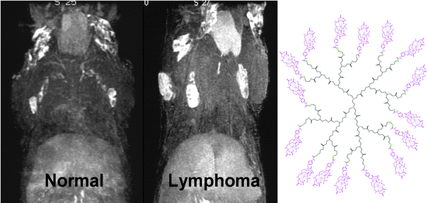 MR Lymphangiogram of a normal mouse (left) compared to a IL-15 transgenic, lymphoproliferative/lymphoma mouse (right), utilizing 0.005 mmol Gd per kg of generation 8 (G8) PAMAM dendrimer (13 nm) at 30 min post-injection. Lymph nodes and lymphatics are visualized through the uptake of the dendrimer agent. Enlarged lymph nodes involved with lymphoma lesions are clearly determined in the lymphoma mouse with MR Lymphangiogram. The chemical structure of generation 2 (G2) based PAMAM dendrimer contrast agent including 1B4M chelate is shown. The G8 contains repetitive extensions of this interior structure three more times.