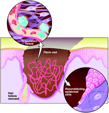 Cartoon to illustrate the main phases in the healing of a skin wound. The tearing is temporarily plugged with a fibrin clot, which is soon infiltrated by inflammatory cells. Later, a dense capillary network and a temporary granulation tissue form. An epidermal layer is reconstituted from the edges of the wound and from the remnants of the pristine cute, hair-like follicles, by the migration of epidermal cells and by production of collagen. Reproduced with permission from ref. 29. Copyright (1997) The American Association for the Advancement of Science.