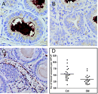 Regulation of angiogenesis by dietary sphingomyelin. Sections of tumors from the control group (Ctrl) and SM-fed group (SM) were immunostained with VEGF (A, B) or Pecam-1 (C). A moderate to high expression of VEGF was detected in the lower grade ducts of the control group (A) with high levels in higher grades (unspecific luminal staining). Low to moderate levels were seen in the SM-fed group (B). PECAM-1 staining was used to visualize endothelial cells (C), and blood vessels were counted in 10 high-powered viewing fields (HPVF) per section (D). The number of blood vessels per HPVF was significantly higher in the control (Ctrl) group than in the SM-fed group (p < 0.001).