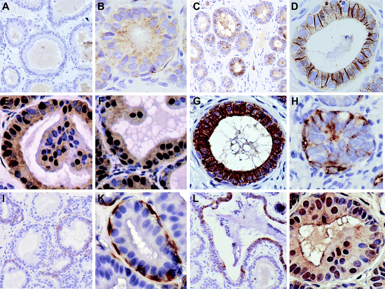 Expression levels and the localization of proteins associated with breast cancer progression are altered with dietary SM. E-cadherin expression in the control group (A low, B high magnification) and the SM-group (C low, D high magnification); H4K16ac in control (E) and SM-group (F); (G) cytokeratin expression confirms the epithelial origin of the ducts; (H) Vimentin expression in the control group; (I, K) Vimentin-positive myoepithelial cells; (L) SK1 expression; (M) ceramide kinase expression (the luminal staining of the duct-like structure is unspecific).
