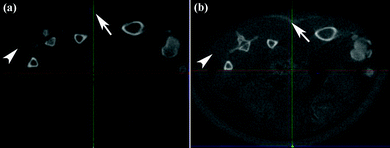 CT image of a mouse with 50 μL of [(Ag0)75-G5.NHAc] DSNPs ([Ag] = 0.1 mol L−1) subcutaneously injected into its back on the left at 5 min (a) and 25 min (b) post injection. The white arrow points to the Ag DSNP injection region. For a control experiment, Omnipaque (50 μL, iodine concentration = 0.1 mol L−1) was injected into the mouse's back on the right. The white arrow head points to the inject area of Omnipaque with iodine concentration similar to Ag.