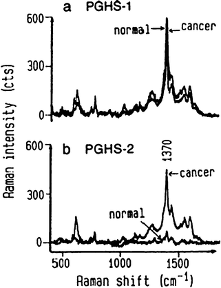 (a) SERS spectra of PGHS-1 in normal and malignant human hepatocytes; (b) SERS spectra of PGHS-2 in normal hepatocytes and malignant cells. (Reprinted from ref. 47. Copyright 1998, with permission from Elsevier).