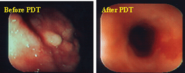 Esophageal tumor (human) treated with HPPH-PDT (Lasers in Surgery and Medicine, 2006, 4, 445).