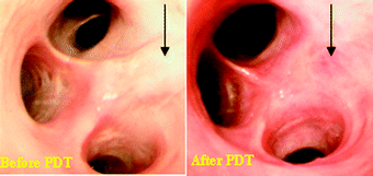 Lung tumors (human) treated with HPPH-PDT.