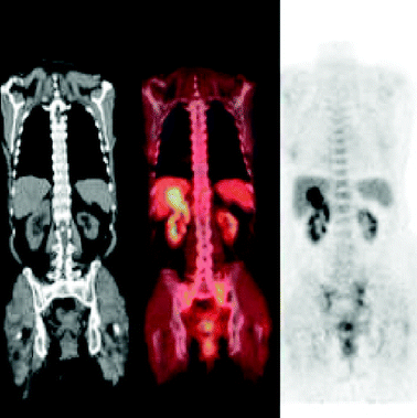 
            [18F]FDG image of a patient with colorectal cancer (left, CT image; middle, fused PET–CT image; right, PET image).