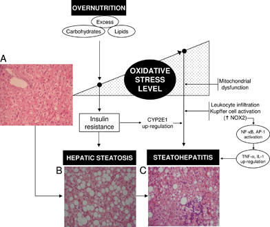 Interrelationships between the level of liver oxidative stress status and insulin resistance (IR) triggering hepatic steatosis and its progression to steatohepatitis in non-alcoholic fatty liver disease (NAFLD) associated with obesity. Overnutrition can trigger the onset of oxidative stress in the liver due to higher saturated fatty acid availability and oxidation, with consequent mitochondrial reactive oxygen species (ROS) production and antioxidant depletion. Prolonged oxidative stress might, in turn, favour n-3 long-chain polyunsaturated fatty acid depletion and IR leading to hepatic steatosis. Exacerbation of the oxidative stress status of the liver in steatohepatitis is associated with several mechanisms, including up-regulation of cytochrome P450 2E1 (CYP2E1) due to IR, mitochondrial dysfunction, and enhanced Kupffer cell and/or infiltrating leukocyte NADPH oxidase (NOX2) activity, with consequent enhancement in ROS generation. Under these conditions, promotion of hepatocellular injury might be ascribed to (i) severe oxidation of biomolecules with loss of their functions; and (ii) activation of redox-sensitive transcription factors such as nuclear factor-κB (NF-κB) and activating protein 1 (AP-1) with consequent up-regulation of the expression of pro-inflammatory mediators at the Kupffer cell level (tumor necrosis factor-α (TNF-α), interleukin (IL)-1). Hematoxylin-eosin-stained liver sections from a control patient (A) and from NAFLD obese patients with steatosis (B) or steatohepatitis (C). Magnification ×70.