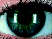 Soft UV radiation-absorbing contact lens covering the entire cornea. (Photograph provided by Dr A. Cullen, University of Waterloo, Canada.)