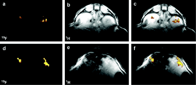 
          19F MR images taken following intravenous injection of PEGylated, fluorinated PAMAM(G3) particulates. (a) 19F CSI image and (b) 1H image reveal the presence of PEGylated particulates in the mouse kidney vasculature. These images are merged in (c). (d) 19F CSI image and (e) 1H image showing the filtration of the PEGylated particulates in the mouse liver. These images are merged in (f). Reprinted from Biomaterials, Vol. 30, Criscione et al., Self-assembly of pH-responsive fluorinated dendrimers-based particulates for drug delivery and non-invasive imaging, p. 3946–3955, Copyright 2009, with permission from Elsevier.