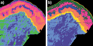 
            UHCA map of cervical tissue section produced from a) raw uncorrected FTIR micro-spectroscopic image and b) RMieS corrected image data. In the RMieS corrected image (b)) the exfoliating cell layer appears in gold, the superficial layer of squamous epithelium is dark green, the intermediate layer is pink and blue, the parabasal layer is orange, the basal layer is yellow and the stroma is light blue and slate blue. In the uncorrected image (a)) the superficial layer of the epithelium has not been separately identified by the UHCA and an additional (light green) cluster has been assigned to the stroma.