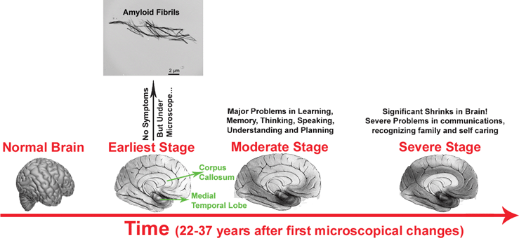 Manifestation of pathology and its progression in AD. In the early stages, there may be no obvious symptoms; however detectable amyloid fibrils, plaques and tangles may be present. The darker areas show the affected parts of the brain. Typically, there is a hierarchical and gradual expansion of the lesions over time. Braak stages I and II (defined by neurofibrillary tangle pathology),18 involving the entorhinal cortex and transentorhinal and the anterior part of the hippocampus, are not reflected by clinical symptoms. Subsequently, the disease progresses to the limbic system (Braak stages III and IV) where mild problems with memory and cognition appear. Finally, the disease spreads to the neocortex (Braak stages V and VI) where moderate problems appear and then leads to severe dementia and AD is very apparent. The hippocampus, particularly the entorhinal cortex, is the first brain region to be affected in AD, it expresses the molecular profile most susceptible to neurotoxic factors in AD.17 In addition, the pathology would spread in the brain as a retrogenesis sequence.19 Indeed, those structures that have matured later during the growth of the individual (myelinated at the end of adolescence), such as the prefrontal cortex, would be the most fragile and the first affected. Areas involved in orientation and language that became mature at puberty would follow. By contrast, the first myelinated structures, such as the primary sensitive areas, would remain intact in AD.