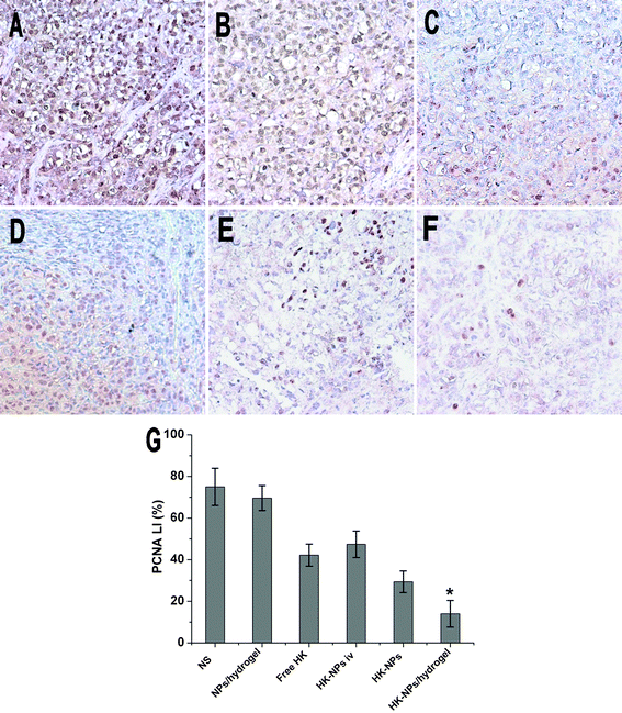 Inhibition of cell proliferation assayed by PCNA staining. Representative sections were taken from SKOV3 tumor tissue of NS (A), blank NPs/hydrogel (B), free HK (C), HK-NPs iv (D), HK-NPs (E) and HK-NPs/hydrogel (F) treated groups. The PCNA-positive cells in HK-NPs and HK-NPs/hydrogel groups were significantly less when compared with controls (P < 0.05), and the HK-NPs/hydrogel-treated group showed a better anti-cell proliferation effect (G).