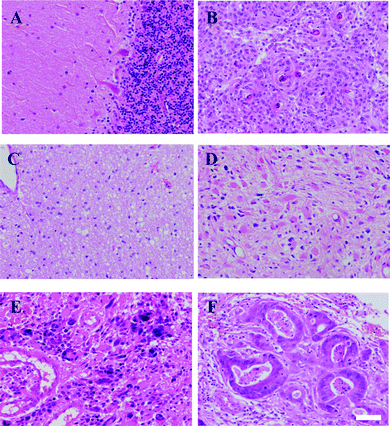 Microscopic images of normal and different tumour subtypes of the brain. Haematoxylin and eosin (H&E) staining of normal brain (Nor) tissue is shown in (A); low-grade tumours like meningioma (Men) in (B); Glioma WHO grade II or low-grade astrocytoma (LA) in (C); high-grade tumours like Glioma WHO grade III or anaplastic astrocytoma (AA) in (D); Glioma WHO grade IV or glioblastoma multiforme (GBM) in (E); and, metastatic brain tumours (Mets, primary colon cancer) in (F). Scale bar = 50 μm.