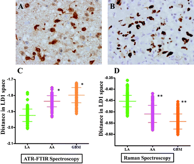 Comparative analysis of glioma tumours using immunohistochemistry (IDH1 and p53 staining) vs. vibrational spectroscopy. (A) shows characteristic staining for IDH1-R132H; and, (B) for p53 in low-grade glioma. LD1 scores plots from PCA-LDA representing spectra from LA, AA and GBM are shown in (C) for IR spectra and in (D) for Raman spectra. P-values from scores plot results using ANOVA test show that LA tumours were statistically significant from other gliomas (*, P ≤ 0.05; **, P ≤ 0.01).