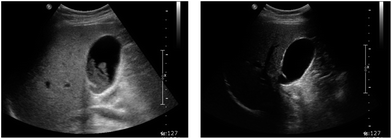 Ultrasonographic images of before (left) and after (right) medical dissolution therapy for gallstones. A 28 year-old female patient was treated with a regimen in which Korean red ginseng was added to the bile acids and gallstones were dissolved completely after 24 weeks.