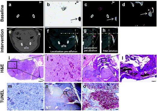 Assessment of treatment response after radiofrequency ablation (RFA) using 124I-cRGDY-PEG-C dots (a–c) Single-dose 124I-cRGDY-PEG-C dot localization of the SLN. (a) Baseline coronal CT (white arrowhead), (b) PET (black arrowhead), and (c) fused PET-CT images (white arrowhead) following a peritumoral injection. (b–d) Tumor 124I-cRGDY-PEG-C dot activity. (b) PET-avid exophytic left pelvic mass (black arrow). (c, d) Combined PET-CT images showing a PET-avid lesion (white arrow) and 124I-cRGDY-PEG-C dot flow within a draining lymphatic channel (asterisk) towards the SLN (curved arrow). (e, f) Pre-ablation axial CT images locate the SLN (e, white arrowhead) prior to RFA electrode placement (f, arrow) into the node (below crosshairs). (g) Pre-ablation fused PET-CT reveals increased SLN activity (posterior to cross-hairs). (h) Post-ablation PET-CT scan shows mildly reduced activity at the SLN site, anterior to the needle tip. (i) Corresponding pre-ablation H&E staining of core biopsy tissue from the SLN confirms pigmented tumor infiltration (bar = 200 μm). (j) High magnification of boxed area in (i) reveals large, rounded pigmented clusters of melanoma cells (bar = 50 μm). (k) Post-ablation H&E staining shows necrotic changes within a partially tumor-infiltrated node (box) and multifocal hemorrhages (bar = 500 μm). (l) High magnification of (k) reveals significant tissue necrosis (arrowheads) within the metastatic node, in addition to lymphoid tissue (bar = 50 μm). (m) TUNEL staining of metastatic SLN before ablation (bar = 20 μm). (n) Post-ablation TUNEL staining demonstrating focal areas of necrosis (red) with adjacent scattered tumor foci and normal nodal tissue (NT) (bar = 500 μm). (o) High magnification of boxed area in (n) shows positive TUNEL staining (red area), consistent with necrosis (bar = 20 μm).