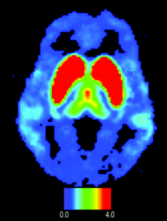 PET image of D2/D3 dopamine receptors distributed in a human brain obtained with microfluidically produced [18F]fallypride. The color bar shows binding potential. Note uptake in temporal lobes and frontal lobe.