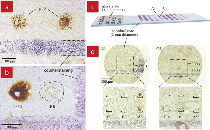 Localized immunohistochemistry (IHC) executed using a MFP on 4 μm thick, well-differentiated invasive ductal carcinoma breast tissue sections. (a) Several spots on the same slice were stained to target the tumour suppressor protein p53. (b) Multiplexing was achieved by staining two different target proteins, the p53 and the progesterone receptor (PR) on the same slice. (c) A tissue microarray of infiltrating ductal carcinoma breast tissue. Each individual core is 2 mm in diameter. (d) Selected cores of the tissue array (here A2 and B5) stained for p53, progesterone, and estrogen receptor (ER) proteins. Each core was stained for each protein twice, once at 150 s residency time of the MFP, and once at 300 s. These images illustrate the potential of the MFP for medical applications.