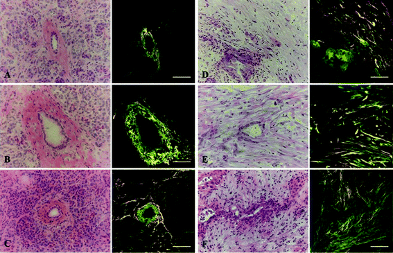 MPE and SHG imaging of human pancreatic tissues. Three normal ducts (A–C) and three PDAC ducts (D–F) from different individuals were identified. Shown is the H&E image of each duct. Each duct was imaged for eosin fluorescence (green) and SHG signal (orange), which were then merged to depict collagen fibers in relation to epithelial cells comprising the duct. Collagen appears organized in a loose, concentric pattern around normal ducts but becomes linearized and aligned around PDAC ducts. Scale bars represent 100 μm.
