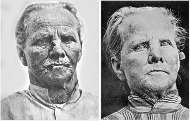 Patient with “rodent ulcer” treated by Jesionek & Tappeiner (a) before, and (b) after PDT with topical 5% Magdala-red solution and sun exposure. From: Dtsch. Arch. Klin. Med., 1905, 82, 223–226.