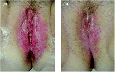 (a) EMPD before MAL-PDT. (b) EMPD after 2 MAL-PDT sessions treatment.