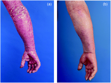 Right arm of a patient with SS (a) before ECP showing diffuse redness and severe scaling and (b) after 5 years of continuous treatment.