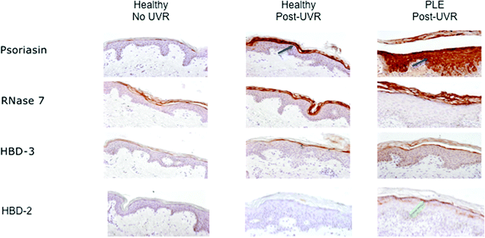AMP expression in healthy skin and UVR-provoked PLE rash. From left: unexposed skin from healthy volunteer; healthy skin post-2 MED; PLE-affected skin following UVR provocation. Blue arrows indicate strong upregulation of psoriasin expression in the upper epidermis of healthy skin post-UVR, and dramatic increases in its expression throughout the epidermis following UVR-provocation of PLE; RNase-7 (strongly) and HBD-3 (modestly) were similarly upregulated in UVR-exposed healthy skin and provoked PLE compared with unexposed healthy skin; HBD-2 was not upregulated in healthy skin following UVR exposure but did show some increase in the upper epidermis of PLE-affected skin (green arrow).