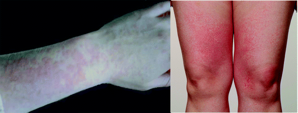 Polymorphic light eruption: typical appearance of erythematous papules on photoexposed sites. Patient consent gained for publication of these photographs.