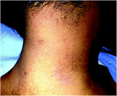 20 year old male (skin type IV) with polymorphous light eruption (PMLE). Grouped pinhead-sized erythematous shiny papules and excoriations over the neck.