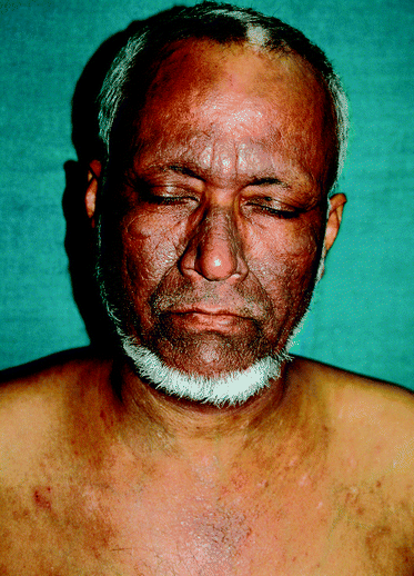 55 year old Indian man (skin type V) with chronic actinic dermatitis (CAD). Hyperpigmented lichenified plaques with prominent skin markings over photoexposed sites on forehead, cheeks, nose and front of chest while sparing the nasolabial folds and upper eyelids.