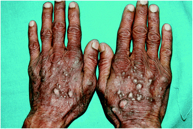 50 year old Indian farmer (skin type V) with chronic actinic dermatitis with prurigo-like lesions on dorsae of hands having patch test and photopatch testing positive to parthenium.