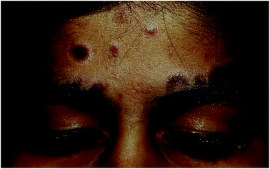 14 year old girl (skin type IV) with actinic lichen planus. Multiple bluish black hyperpigmented plaques, a few showing central atrophy over forehead. Note striking perilesional hypopigmentation.