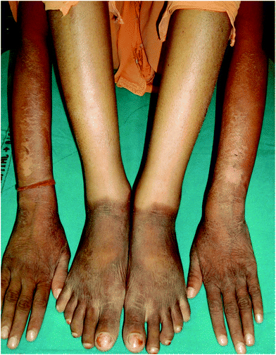 30 year old lady (skin type V) with pellagra. Dry minimally scaly brownish hyperpigmented plaques over photoexposed sites on the forearms and dorsae of hands and feet. Note well defined lateral border on the forearm and sharp cut off at the ankles.
